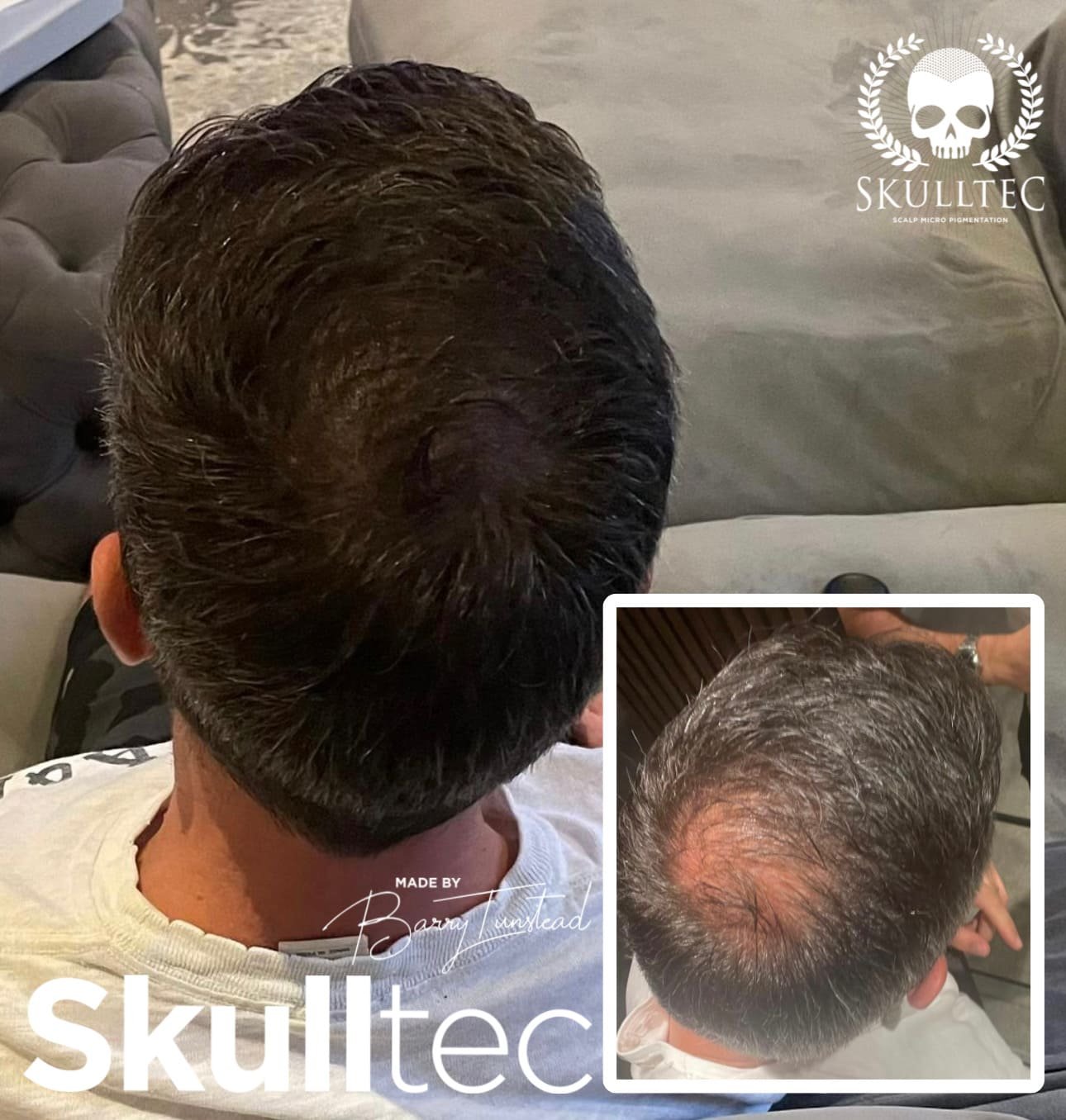Hormonal Hair Loss Solution In Scotland